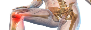 Artrosis de rodilla
